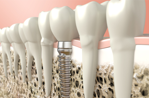 インプラント治療とは