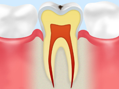 CO【ごく初期の虫歯】
