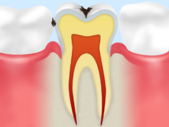 C1【エナメル質の虫歯】