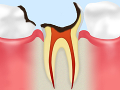 C4【末期の虫歯】