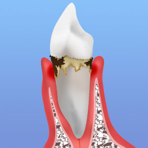 【初期の歯周病】