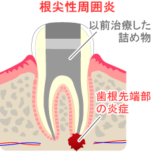 痛み止めを飲んでも痛みがおさまらない⁈　～感染で痛み～