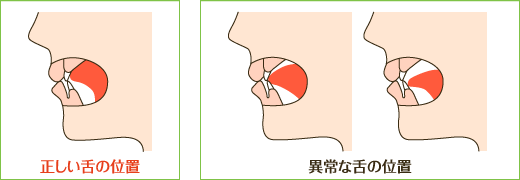 お子様の舌の位置は大丈夫ですか⁈