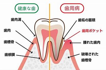 歯周病が慢性化すると、細菌の侵入がアップする⁉