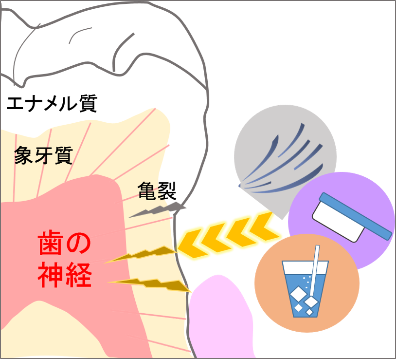 歯がしみる！　～夏になって冷たいものがおいしいけど～　虫歯との違いは？