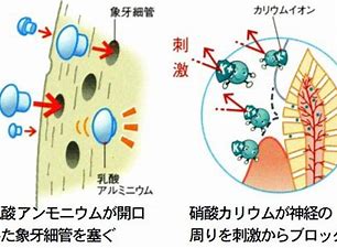 歯がしみる！　～夏になって冷たいものがおいしいけど～　知覚過敏の治療は？