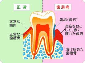 これでバッチリ！歯周病予防！