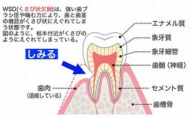 歯磨きの力が強いと・・・　知覚過敏や歯茎下がりに