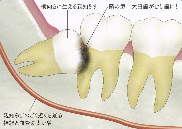 親知らずは抜歯しないといけないの？　　～リスクを考えて抜歯しよう～