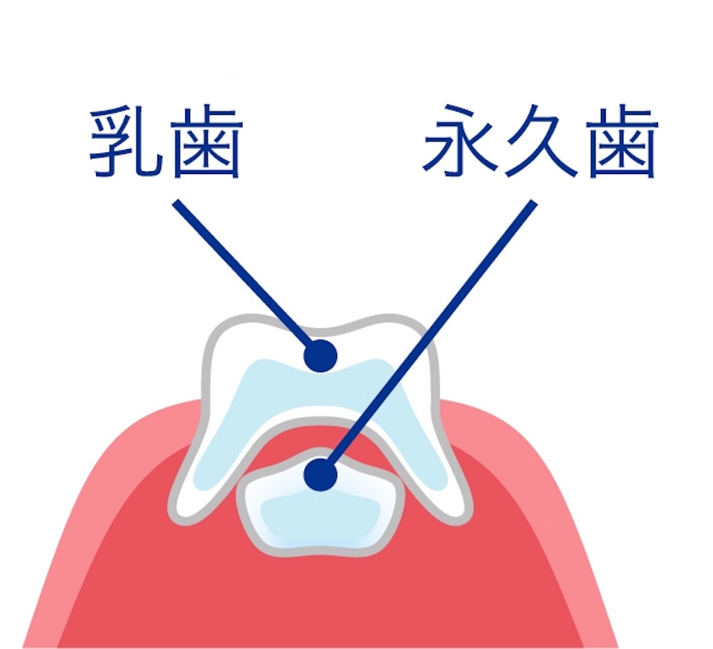 乳歯抜けたけど、永久歯が出てこない！