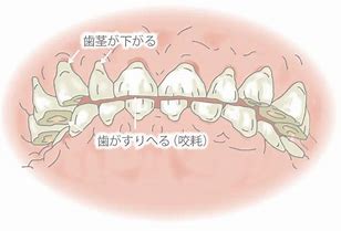 よく被せ物が取れたり、歯が欠けるのは歯ぎしりが原因!?