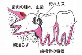 その親知らず放置して大丈夫!?　～早めに抜歯してみたら～