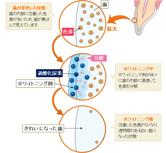 ホワイトニング効果の歯磨き粉って、ほんとに白くなるのか？　～漂白効果はありません～