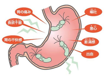 胃がんの原因の1つのピロリ菌はお口の中にも！　