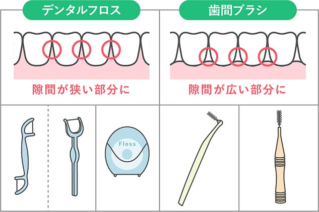 デンタルフロスと歯間ブラシは歯の間を掃除するものだけど・・違いは？