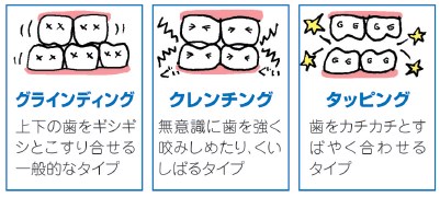 前歯がガタガタしているので揃えたい！　～原因は歯ぎしり～