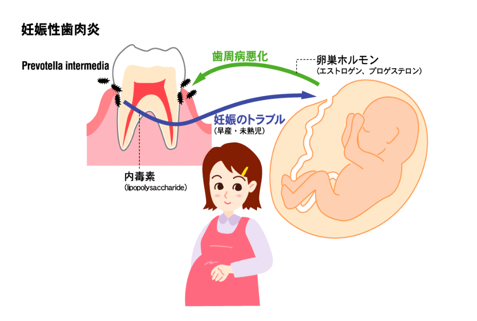 妊娠中はなぜ歯周病になりやすいの？