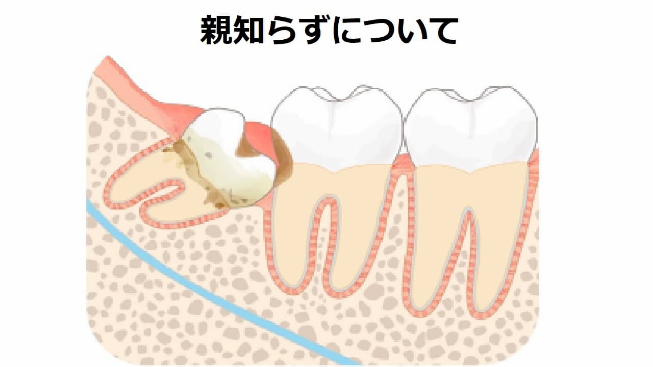 親知らず抜くと小顔になるって聞いたけど・・・そんなことはありません！