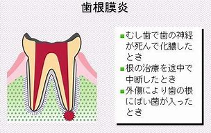 神経を取ったけど歯が痛い？