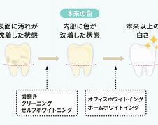 セルフホワイトニングの薬剤は？　　～主に汚れを落とすだけ～