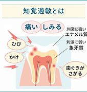 知覚過敏症の症状も様々あります！