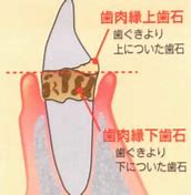 「歯石」について知ろう！　　～定期的なクリーニングが大事！～