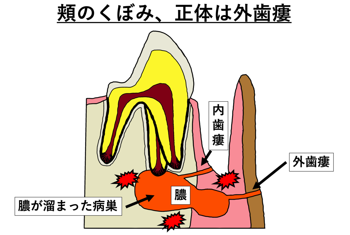 歯の病気が皮膚にも出る！　～外歯瘻って何？～