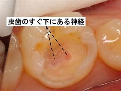 歯の詰め物をしたところがしみたり痛む！　～また新たな虫歯なの!?～