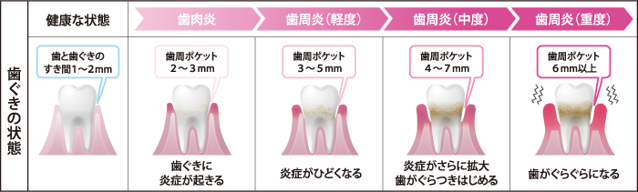 歯周病と歯槽膿漏って同じ？