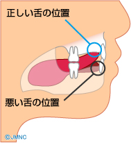 お子様の舌、正しい位置にありますか？