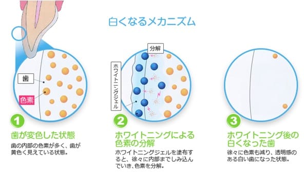 ホワイトニングの歯磨き粉を使っていても歯が白くならない?!　