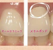 その差し歯、気になりませんか？きれいにしませんか？