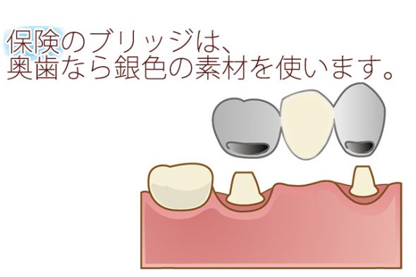 奥歯を抜いた後のブリッジは白くできないの？　　～保険では銀歯～