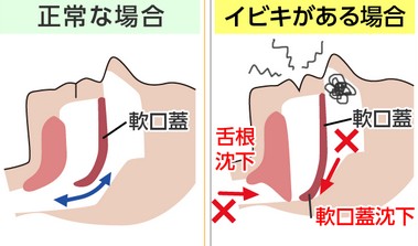 口呼吸はいろいろデメリットがある！　　その③いびきや睡眠障害の原因になる