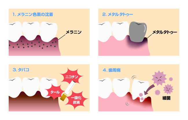 歯茎の黒ずみが気になる！　　～原因と対策～