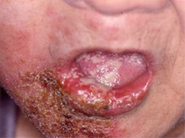 帯状疱疹はお口の中にもできる！
