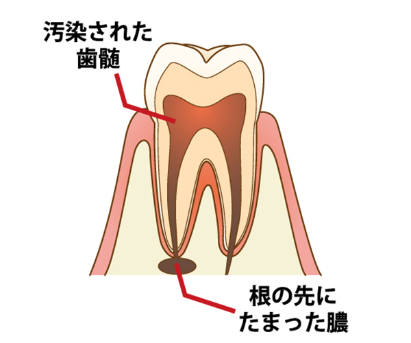 虫歯の治療をしたけど歯茎が腫れた！　　～神経が死んでしまったかも～