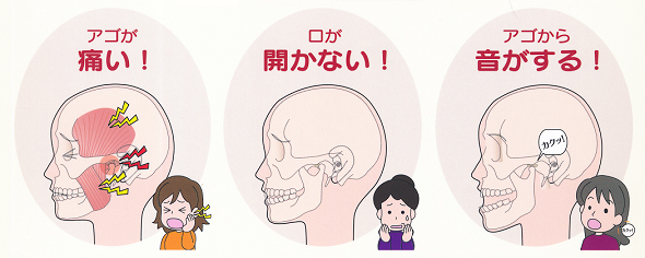 大きく口を開けると「ガクッ」と顎の音がします！　　～顎関節症について～
