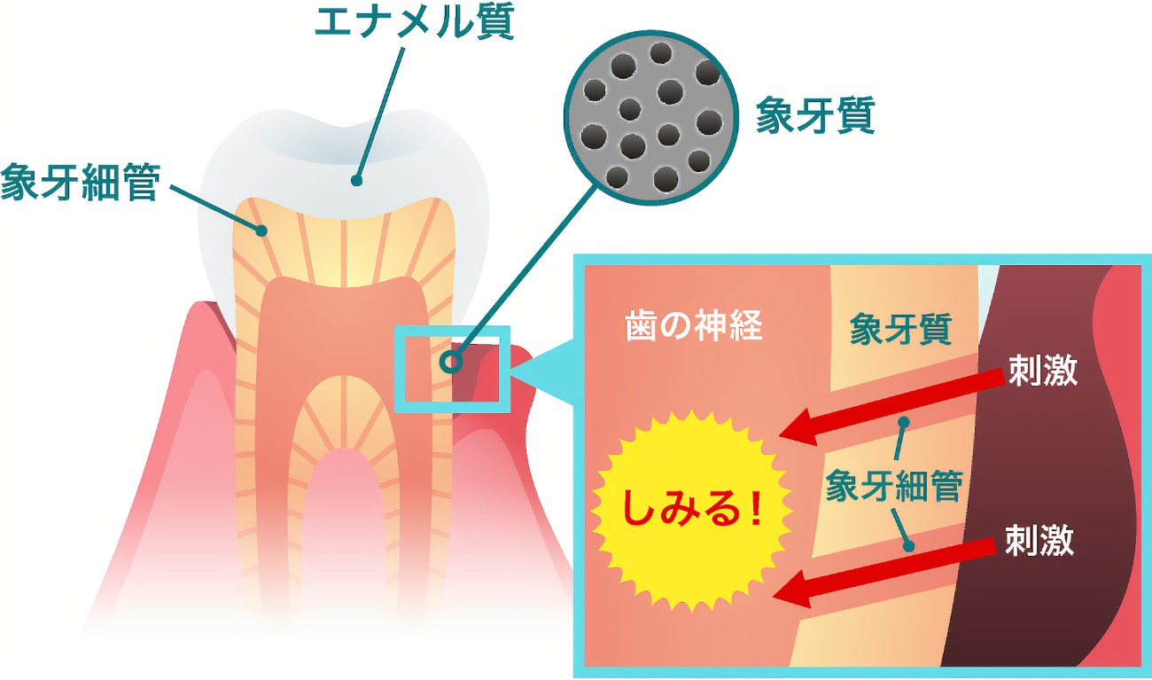 アイスキャンディや冷たい飲み物がしみる！　～知覚過敏～