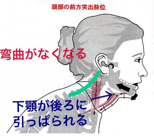 猫背だと顎関節症になりやすい!?　　