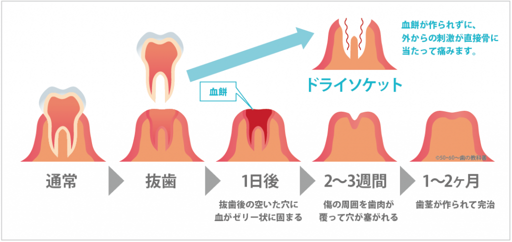 歯を抜いたのに痛みが続く！　　～ドライソケットについて～