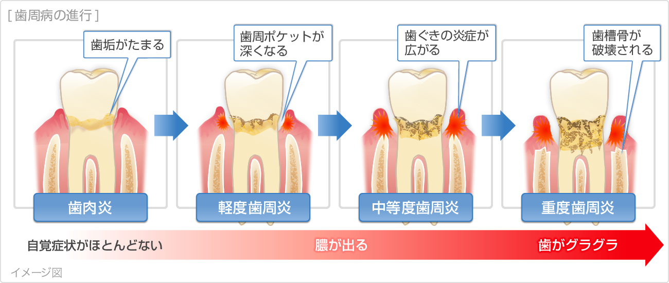 「歯周病」と言われても通ってくれない方が多い！　～症状出てからはどうしようもない～
