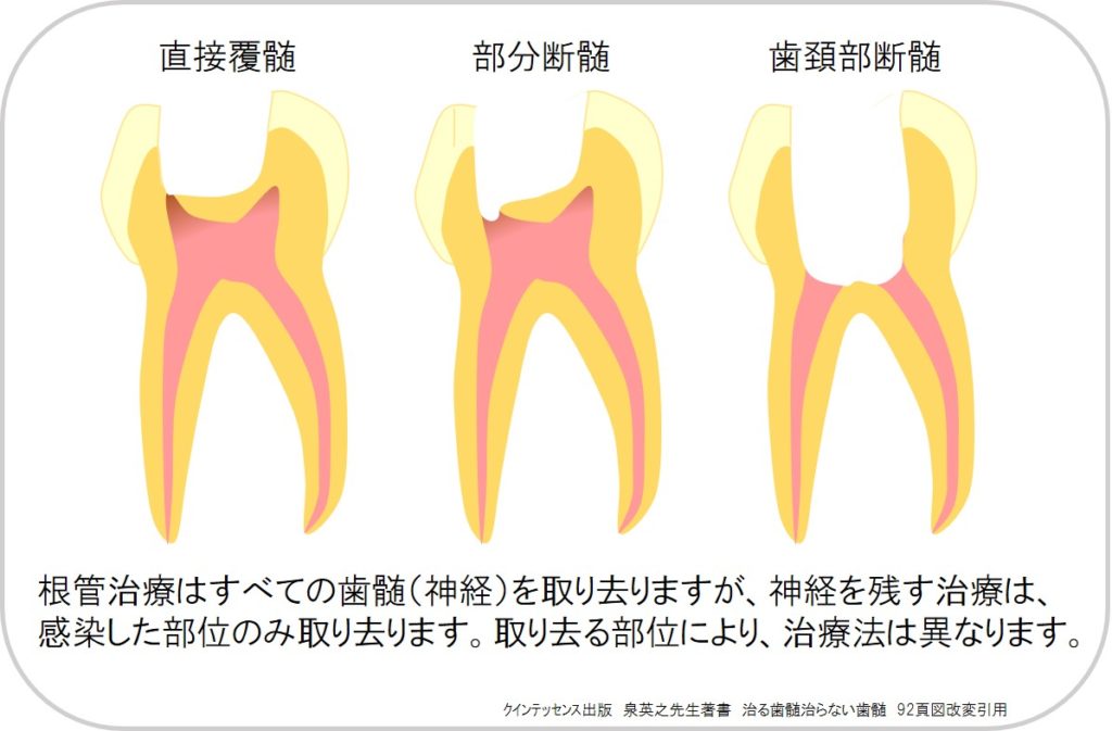 大きな虫歯、深い虫歯で痛みが大きくても神経を残すことあります！