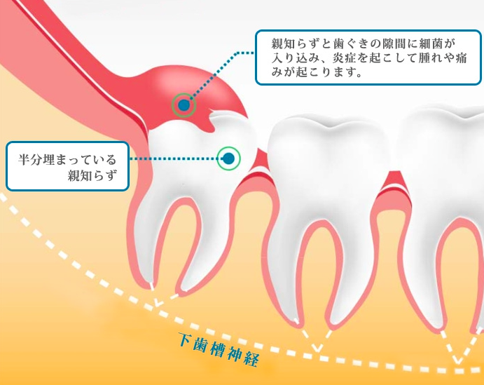 口が開かなくなった！　　～顎関節症でなく智歯周囲炎で～