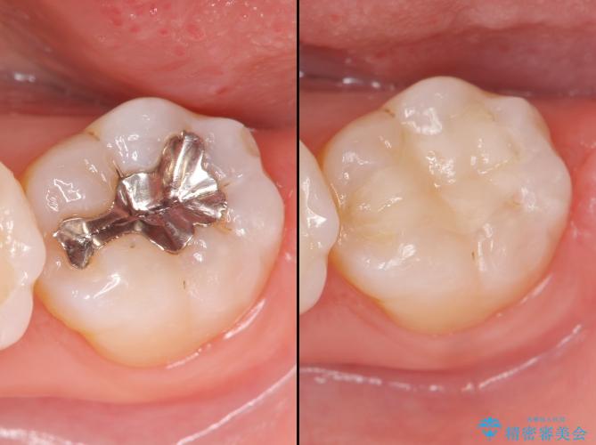 奥歯の被せ物がよく取れたり、詰め物がよく欠けたりしますか？