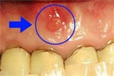 差し歯が腫れた！　治療したばかりの歯なのに・・