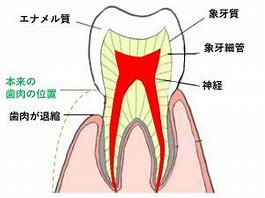 大人の歯茎下がりに気をつけて！