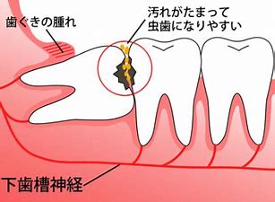 埋まっている親知らずって抜いたほうがいいの？