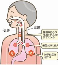 実は恐ろしい！　歯周病が引き起こす全身の病　その2「肺炎」